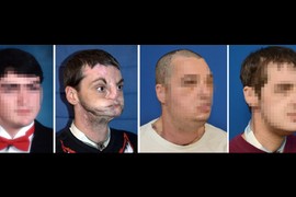 Ovo mu je ostalo od lica nakon PUCANJA U GLAVU! Hirurzi mu TRANSPLANTIRALI NOVO i ovo je ON SADA: Njegova reakcija kad se VIDEO U OGLEDALU dovodi do suza