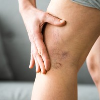 Vadgesztenye visszeres lábakra? Ilyen esetekben érdemes használni