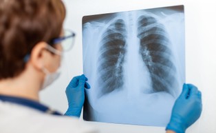 Idiopatyczne włóknienie płuc u 22 proc. pacjentów z ciężkim przebiegiem COVID-19