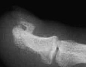 exostosis-d00000BEDe31a1cf665fd