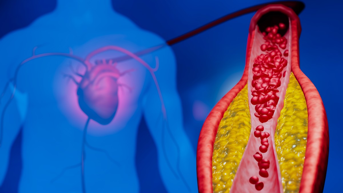 Nivo holesterola i triglicerida može da se poveća nakon jela, ali razlika je u tome kako i koliko brzo