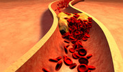 Jesteś młody i szczupły i masz wysoki cholesterol? To może być ta "niewidzialna choroba"