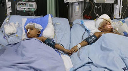 Új hírek a szétválasztott sziámi ikrekről: Rabeya műtéten esett át, Rukaya egy súlyos szövődmény után lábadozik