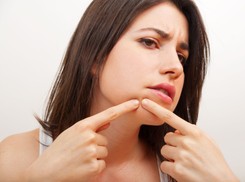 Jest sposób na pryszcza! Naturalne metody