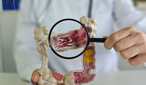 Rak debelog creva raste u svakoj starosnoj grupi mlađoj od 50 godina