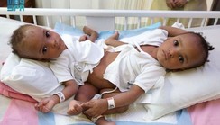 BREAKING: Conjoined Nigerian twins successfuly separated in Saudi Arabia