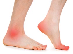 Jak opatrywać pęcherze i otarcia? Pierwsza pomoc