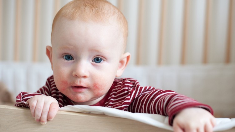 atópiás dermatitisz, ekcéma, atópiás ekcéma, bőrbetegség