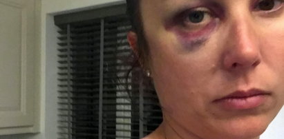 Ofiara bicia pokazała zdjęcia obrażeń. Zrobił jej to mąż biznesmen