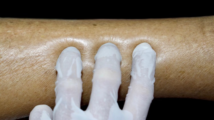 Ödéma végtagokon oedema extremitatum tünet