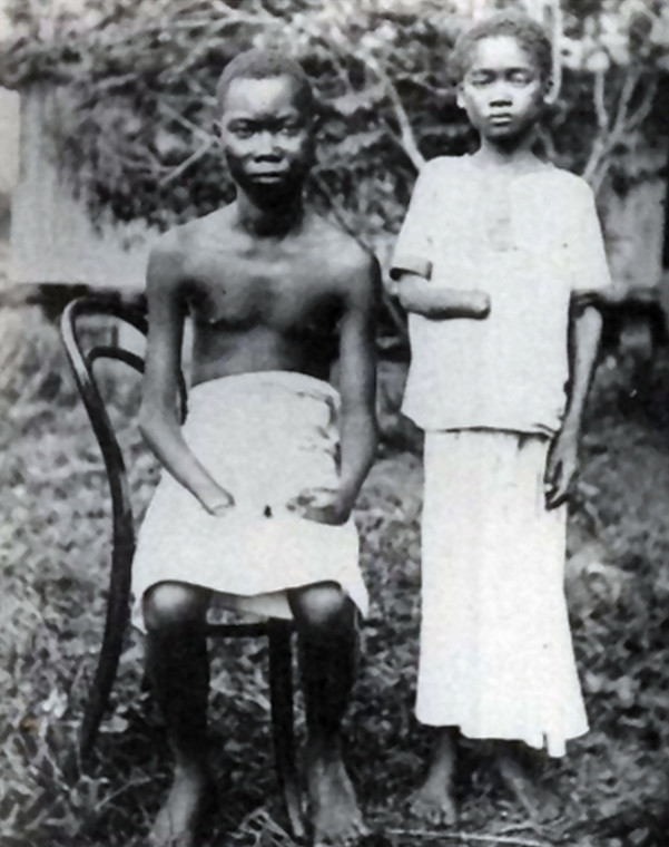 Okaleczeni mieszkańcy Konga