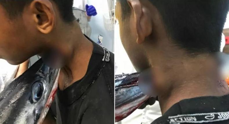 Needlefish stabs boy in the neck injuring him severely