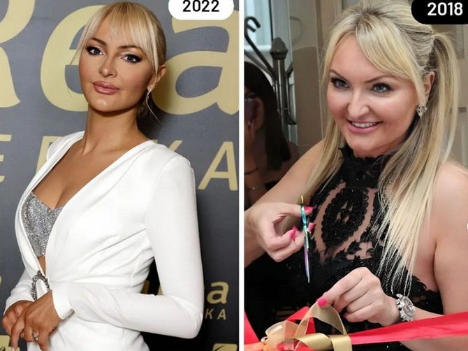Dr Kristina Davidović o estetskim intervencijama na svom licu u emisiji Blic žena studio