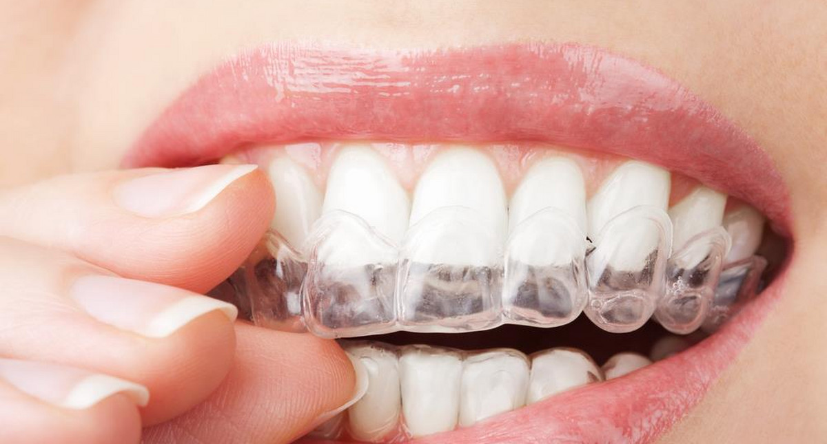 Nakładkowe wybielanie zębów. Przebieg, cena i skutki uboczne