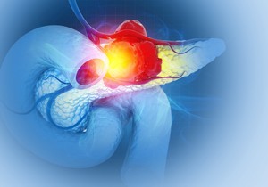 Simptomi raka pankreasa u ranoj fazi često izostaju 