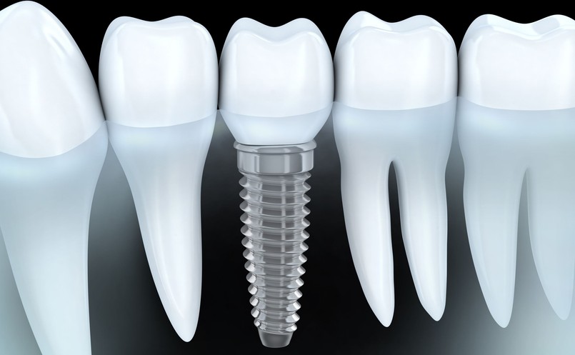 Mit. Jeśli chcesz, aby zęby na implantach służyły Ci wiele lat, dbaj o nie! Korony z implantami, tak samo jak własne zęby, wymagają regularnej higieny – szczotkowania oraz nitkowania. Co prawda ubytki w koronach nam nie grożą, bo większość z nich wykonana jest z ceramiki, która nie podlega próchnicy. Błędna jest jednak teoria, że przy implantach nie grożą nam dolegliwości zębowe i nie musimy odwiedzać dentysty. Przy niewłaściwych nawykach może rozwinąć się np. periimplantitis. – Jest to schorzenie podobne do paradontozy i objawia się zapaleniem tkanek wokół implantu. Główne przyczyny schorzenia to nieodpowiednia higiena jamy ustnej, stres, czynniki genetyczne, palenie papierosów, choroba okluzyjna zębów, a także choroby współistniejące np. cukrzyca, które mogą zaburzać proces gojenia, a co za tym idzie skutkować niepowodzeniem zabiegu. Co więcej, jeśli implant sąsiaduje z zębami, które toczy stan zapalny, to mogą one doprowadzić do infekcji zdrowej tkanki. O odbudowane na implantach zęby trzeba dbać, jak o swoje własne, w przeciwnym wypadku implant może nie zintegrować się dobrze z kością i wypaść – przestrzega lek. stom. Przemysław Stankowski, autor poradnika „Bądź bystry u dentysty”