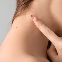 Honnan tudható, ha kóros az anyajegyen talált elváltozás? Bőrgyógyász mondja el