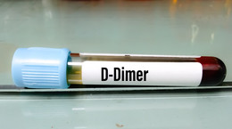 Jak obniżyć d-dimery? Porada lekarza