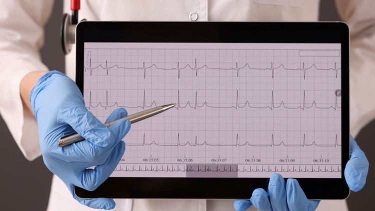 szívritmuszavar szívprobléma pitvarfibrilláció jele stroke tünete