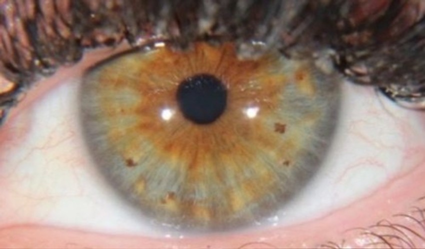 Karline oči nakon udara