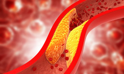 Co powoduje podwyższony cholesterol i jak skutecznie obniżyć jego poziom? Dieta na cholesterol