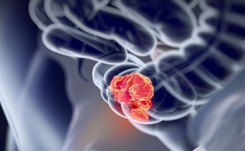 Wykrycie raka jelita grubego we wczesnym stadium jest możliwe tylko dzięki kolonoskopii