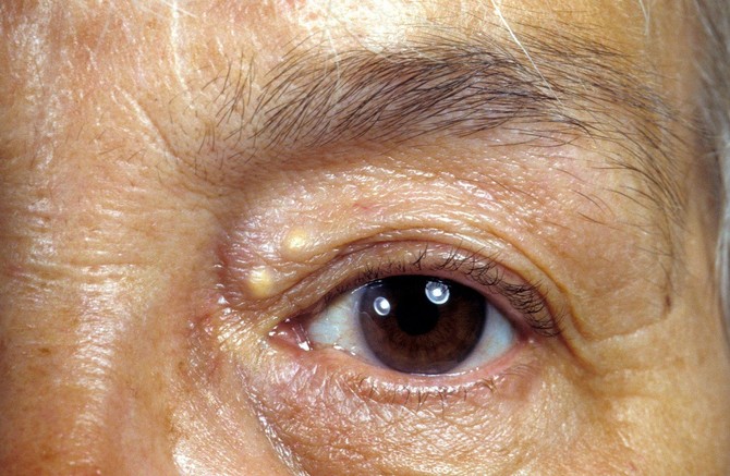 Xanthelasma palpebrarum je stanje koje mnoge brine