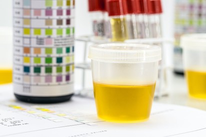 Vizeletvizsgálat előtt ezeket az ételeket inkább kerülje