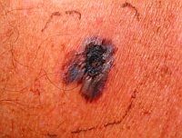 melanoma-d00001BFD410954690771