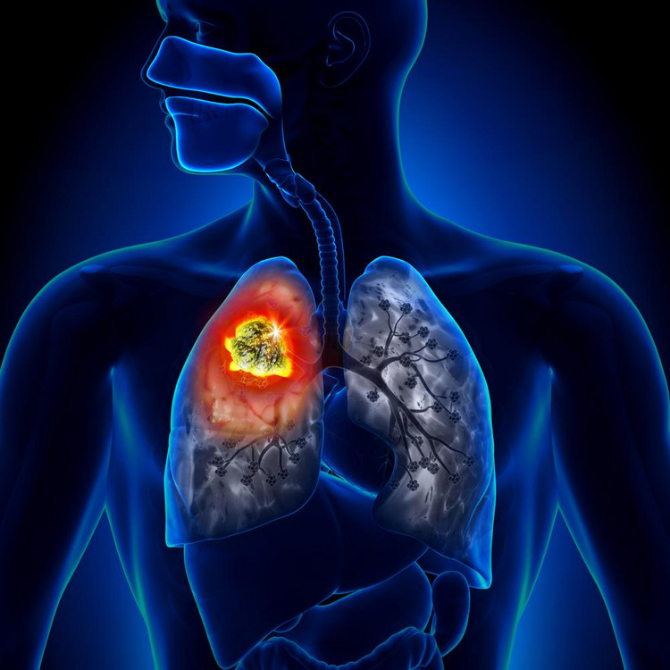 Rak płuca, oskrzeli i tchawicy