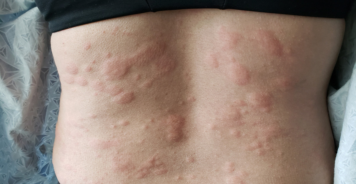 Cztery choroby skóry mogą być symptomem koronawirusa