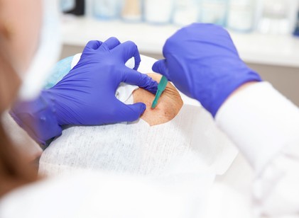 Ekkor lehet szükség bőrbiopsziára: nem csak rákgyanú esetén végzik című cikk nyitóképe