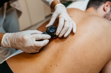 A diagnózist a tünetek alapján állítja fel mindig a dermatológus (bőrgyógyász). A festékes anyajegyek és pigmentált foltok elváltozásainak követésére a legalkalmasabb műszer a videódermatoszkóp, melynek segítségével a bőr felső rétegeibe is betekinthet a szakorvos. A bőrre egy mikrokamerát helyeznek, amely húsz-százhúszszoros nagyítással a felhám alsó rétegéig, az ún. bazális sejtekig képet tud készíteni. Ezek a sejtek szabad szemmel már nem vizsgálhatók. A vizsgálat nem jár fájdalommal, és a beteg számára is láthatóvá teszi a vizsgálat menetébe a képernyőn keresztül az anyajegyet vagy melanómát.