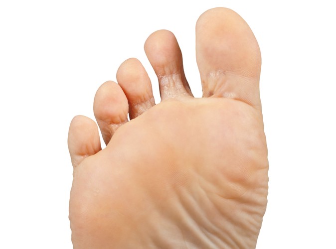 Zmiany skórne to jedyne objawy łuszczycy