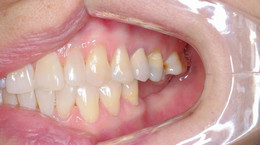 Co powoduje przebarwienia zębów