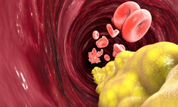 Cholesterol HDL - normy, rola. Jak podnieść poziom dobrego cholesterolu HDL?