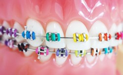 Planujesz założyć aparat na zęby? Sprawdź, jakie to korzyści dla zdrowia