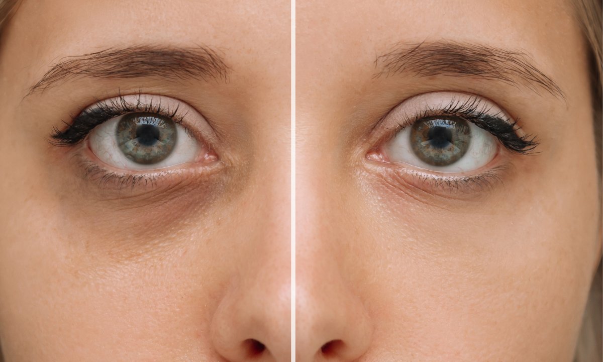 To orzeźwiające żel-serum pokona worki pod oczami! Sińce i zmarszczki znikają w trymiga!