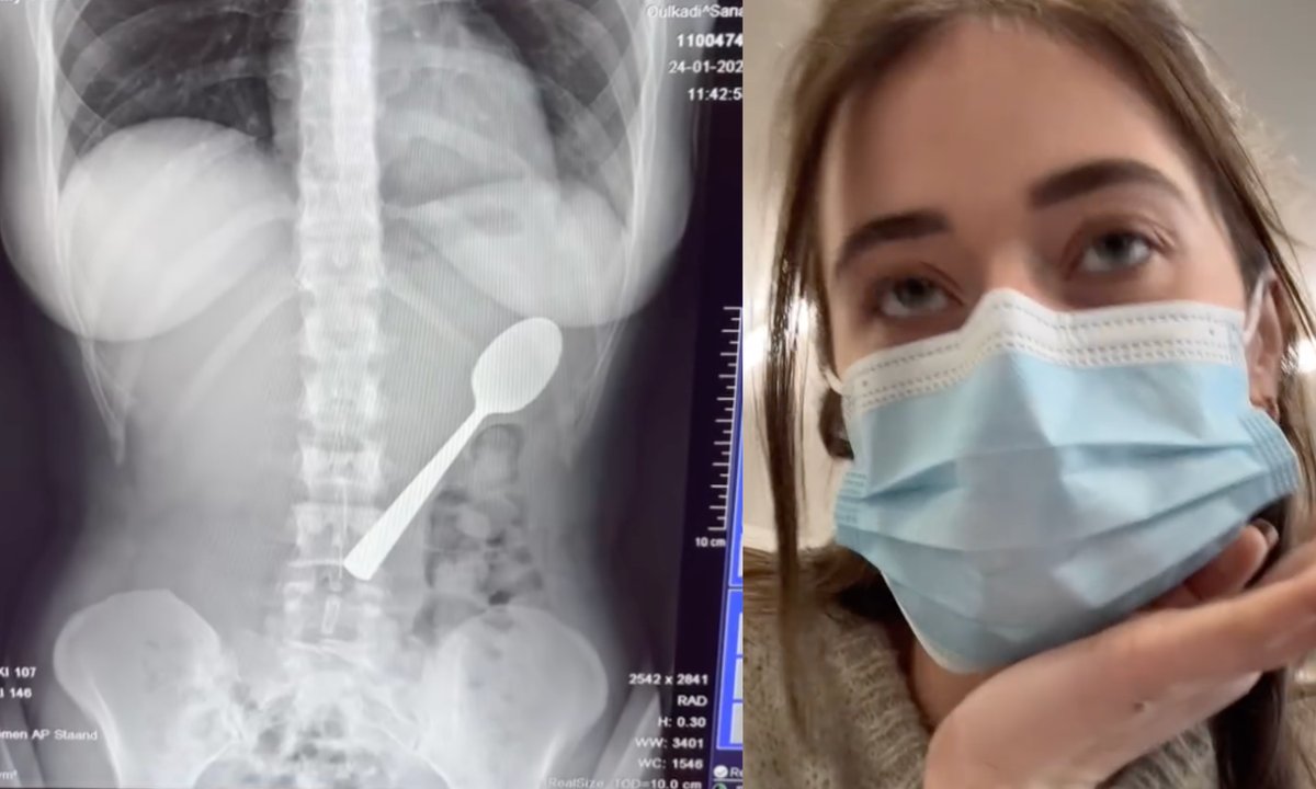 Niewiarygodne, co połknęła, gdy jadła jogurt. "Czułam, jak się przemieszcza"