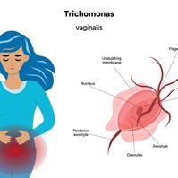 Trichomonas-fertőzés tünetei, vizsgálata és kezelési lehetőségei