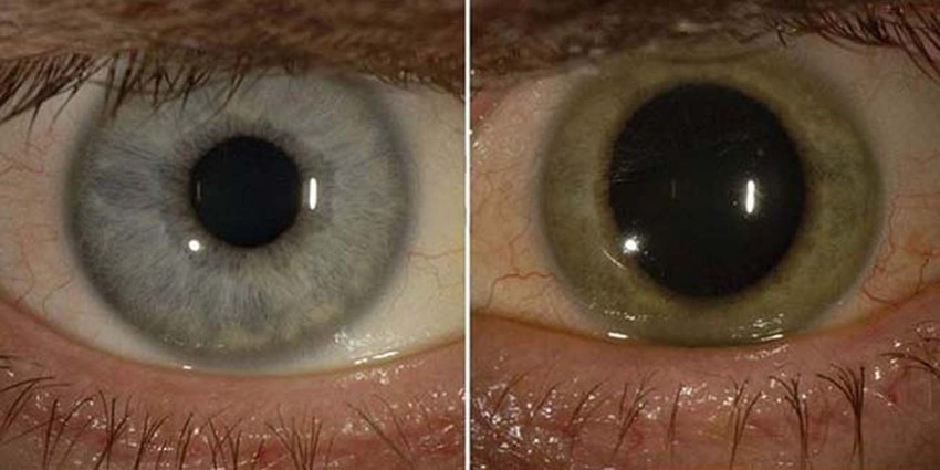 Oko Iana Kroziera je izgubilo plavu boju i postalo svetlo zeleno