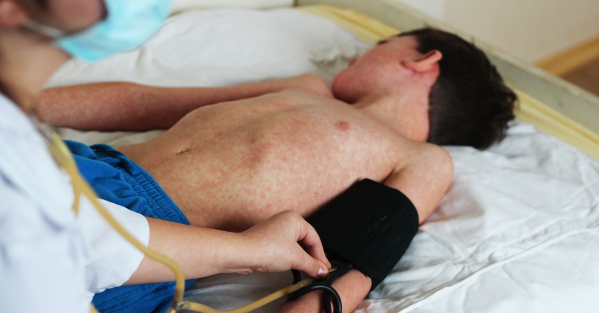 Dawno zapomniana choroba atakuje. Na Podkarpaciu coraz więcej przypadków odry