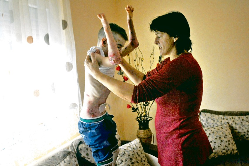 Mučna svakodnevica: I najblaži dodir dečaku nanosi bol