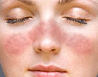 lupus-sle-betegseg-d00000ED2b3b0b2ce226e