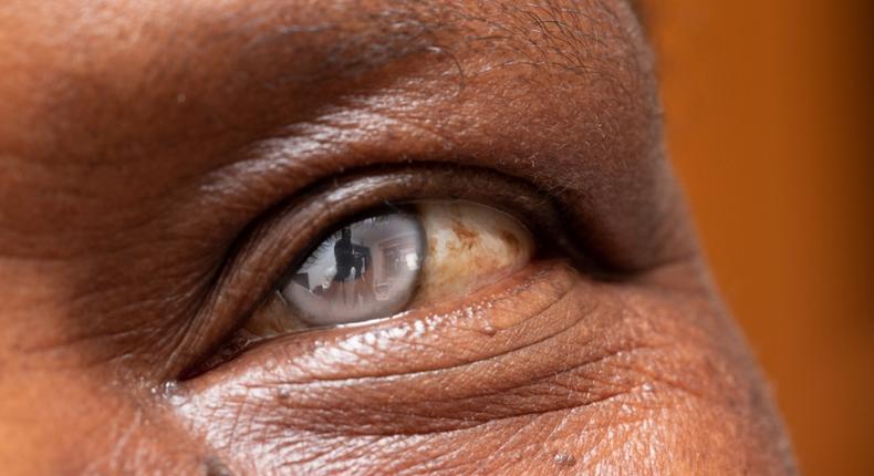 cataracte-cristallin-oeil-operation