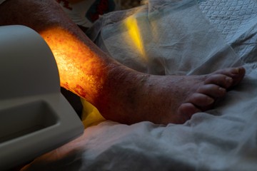 Mi a lábfekély, és hogyan gyógyítható?