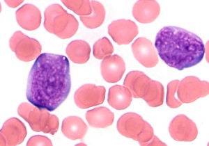 Visok nivo nezrelih krvnih zrnaca u koštanoj srži ili krvi može biti znak raka krvi, poput leukemije