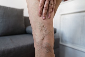 Visszeres lábak és trombózis: így előzze meg a bajt