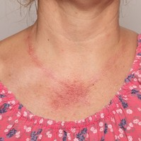 Kiütés, bőrpír a nyakon, dekoltázson, köldökön, csuklón: ettől alakulhat
