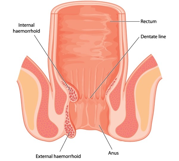 hemorrhoids cukorbetegség kezelése)